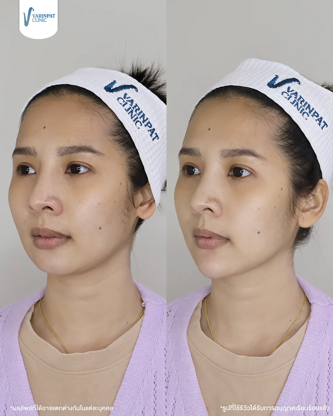 ภาพเปรียบเทียบก่อนและหลังฟิลเลอร์ปากและคางของผู้รับบริการ