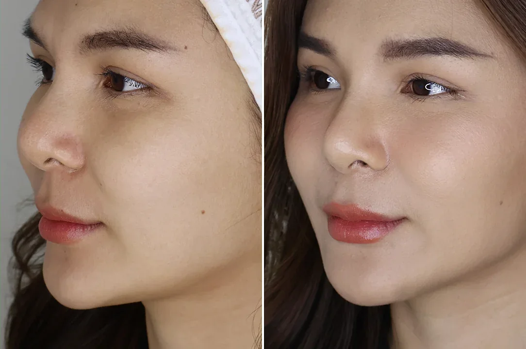 ภาพเปรียบเทียบก่อนและหลังฟิลเลอร์ปรับรูปหน้าของผู้รับบริการ