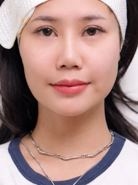ก่อนเข้ารับบริการ · ฟิลเลอร์