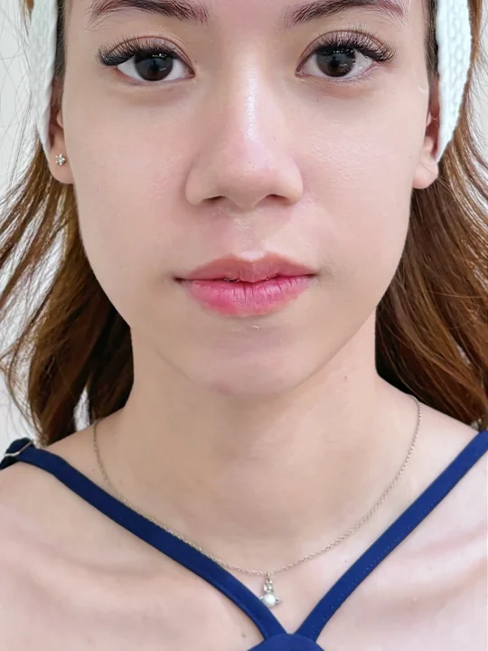 ก่อนเข้ารับบริการ · ฟิลเลอร์ · ขมับ