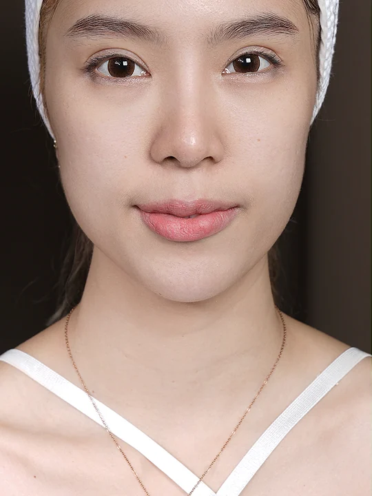 ก่อนเข้ารับบริการ · ฟิลเลอร์ · ขมับ