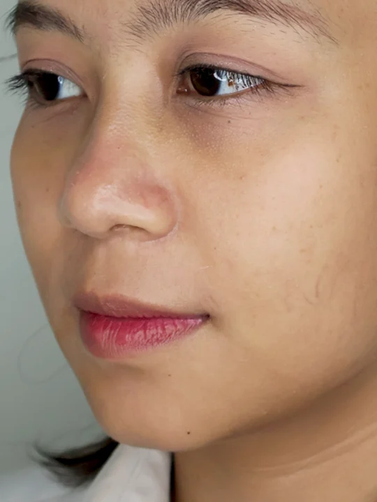 ก่อนเข้ารับบริการ · ฟิลเลอร์ · คาง