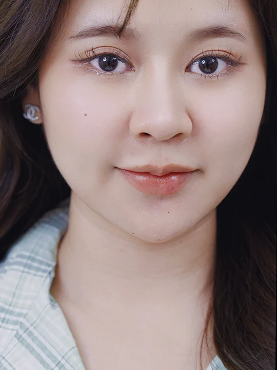 หลังเข้ารับบริการ · ฟิลเลอร์ · คาง