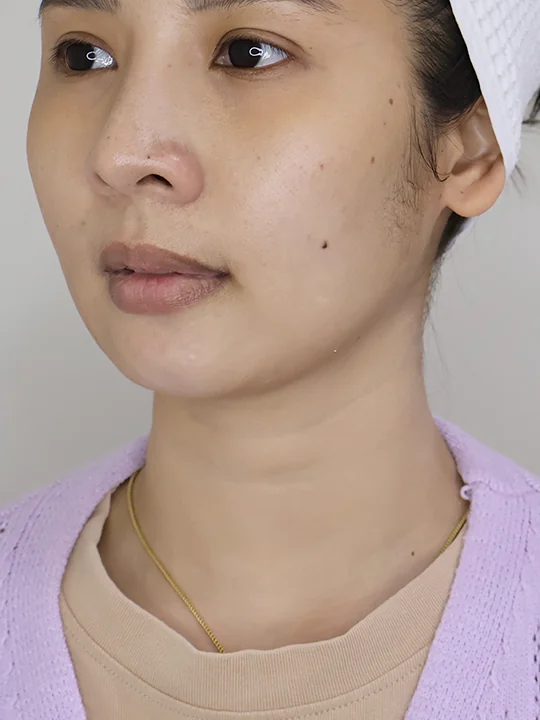 ก่อนเข้ารับบริการ · ฟิลเลอร์ · คาง