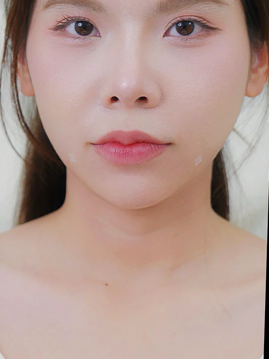 หลังเข้ารับบริการ · ฟิลเลอร์ · คาง