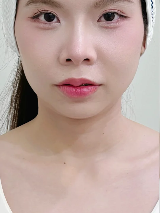 ก่อนเข้ารับบริการ · ฟิลเลอร์ · คาง