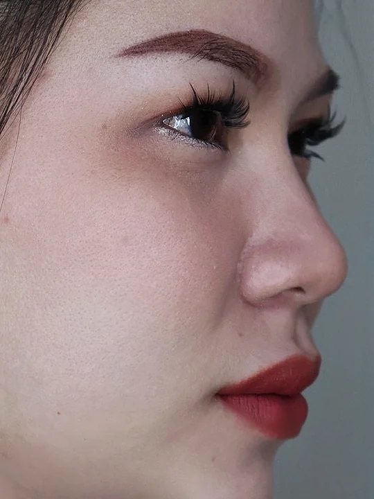ก่อนเข้ารับบริการ · ฟิลเลอร์ · หน้าผาก