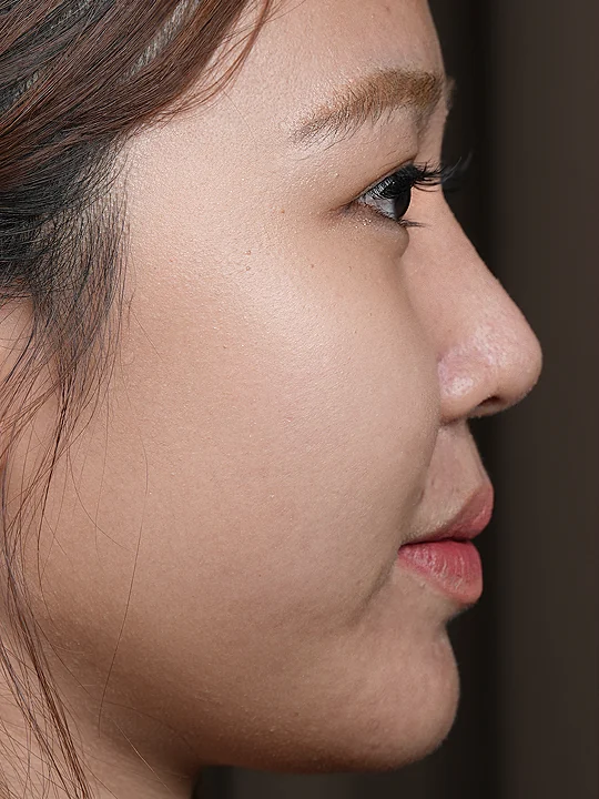 ก่อนเข้ารับบริการ · ฟิลเลอร์ · หน้าผาก