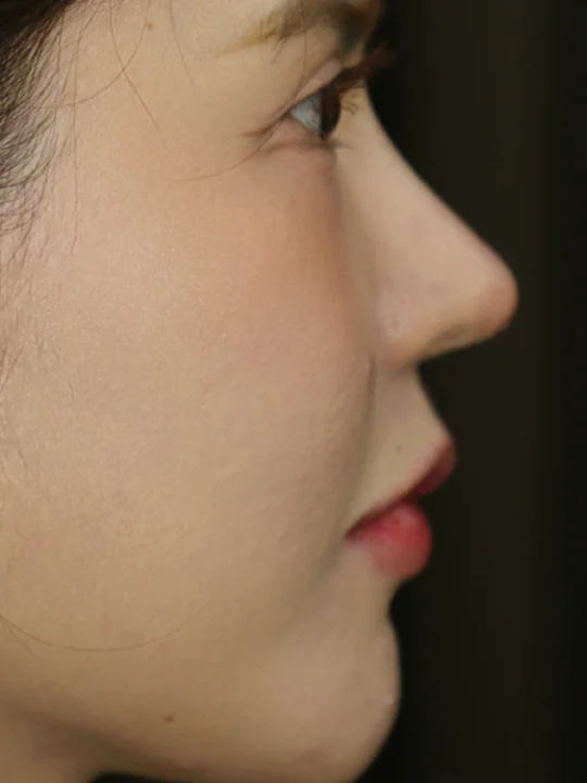 ก่อนเข้ารับบริการ · ฟิลเลอร์ · หน้าผาก