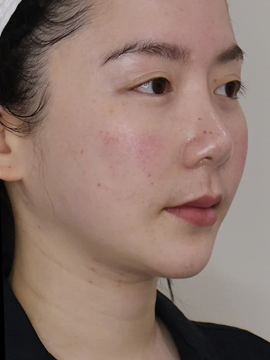 หลังเข้ารับบริการ · ยกกระชับไม่ใช้เข็ม