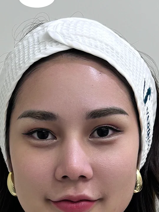 ก่อนเข้ารับบริการ · ฟื้นฟูผิว · Sculptra