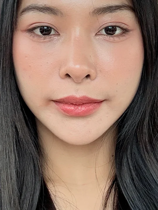 หลังเข้ารับบริการ · ฟื้นฟูผิว · Sculptra