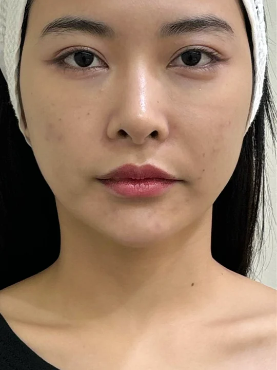 ก่อนเข้ารับบริการ · ฟื้นฟูผิว · Sculptra