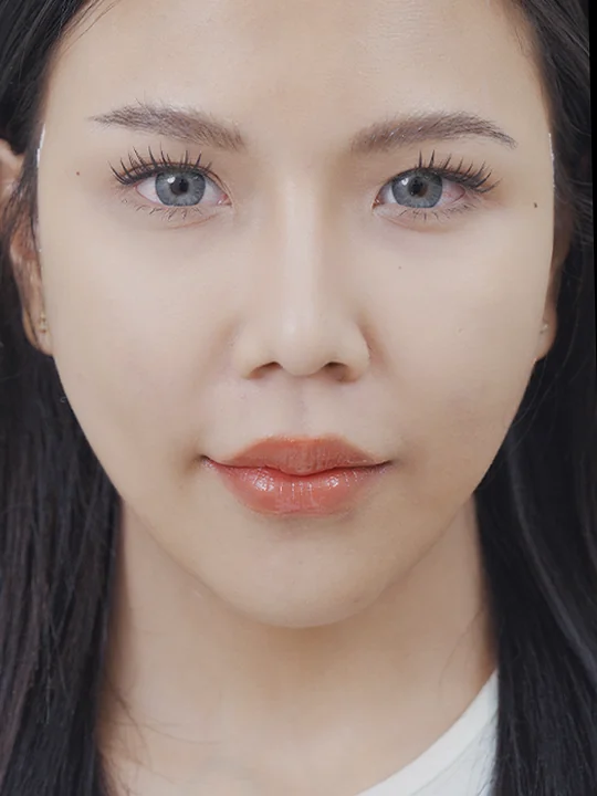 หลังเข้ารับบริการ · ร้อยไหมยกกระชับ