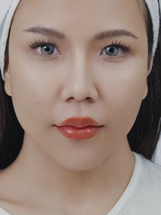 ก่อนเข้ารับบริการ · ร้อยไหมยกกระชับ
