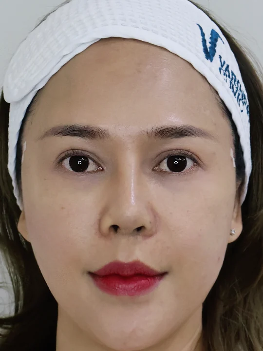 หลังเข้ารับบริการ · ร้อยไหมยกกระชับ