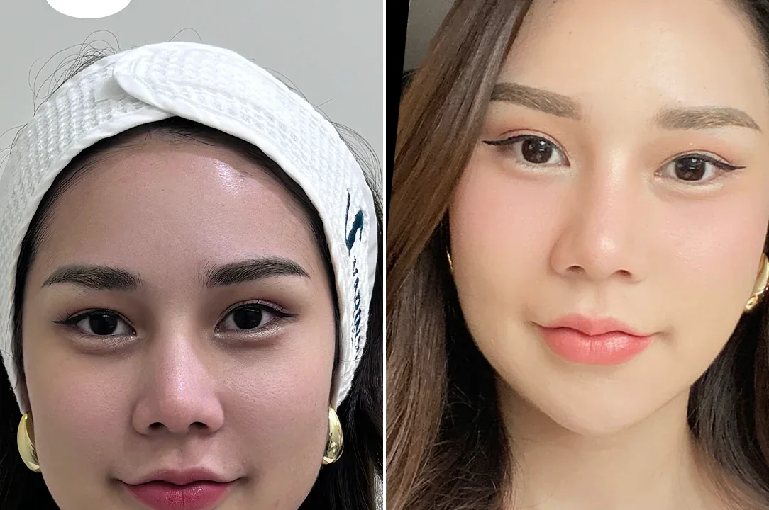 ภาพเปรียบเทียบก่อนและหลังSculptra กระตุ้นคอลลาเจนของผู้รับบริการ