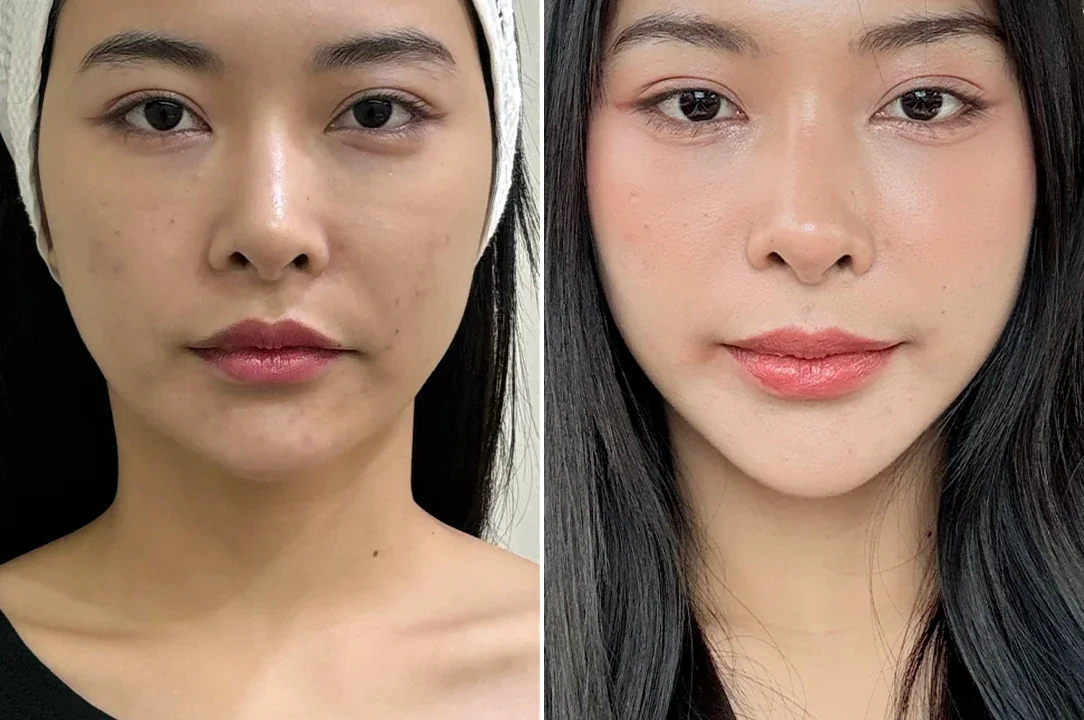ภาพเปรียบเทียบก่อนและหลังSculptra กระตุ้นคอลลาเจนของผู้รับบริการ