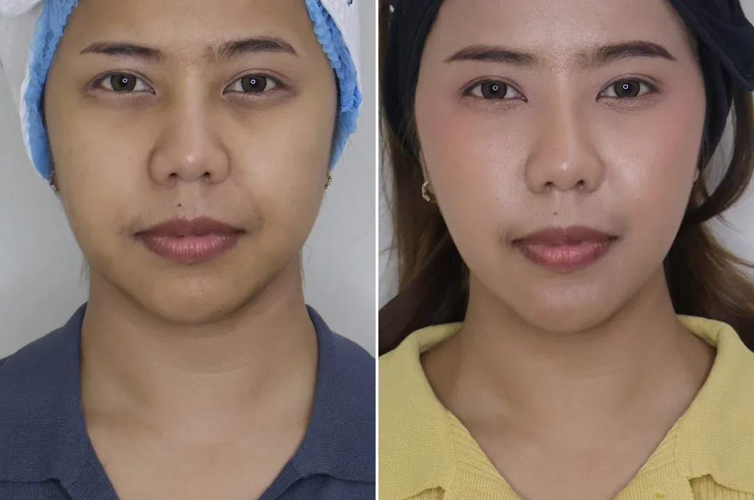 ภาพเปรียบเทียบก่อนและหลังร้อยไหมยกกระชับของผู้รับบริการ