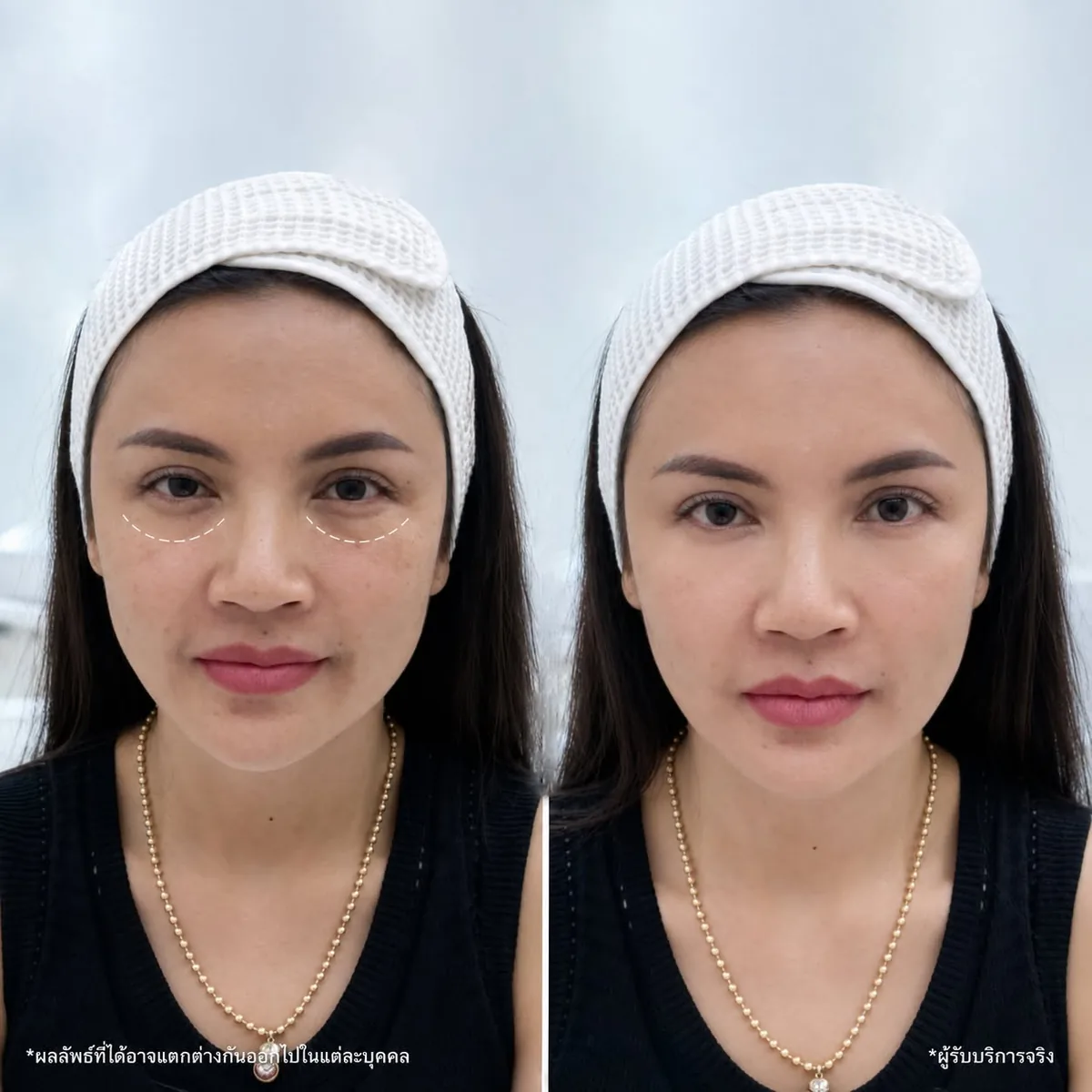 ภาพเปรียบเทียบก่อนและหลังการเติมฟิลเลอร์ใต้ตาของผู้รับบริการอีกราย
